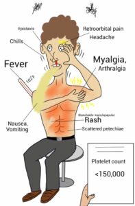 Dengue Fever Treatment